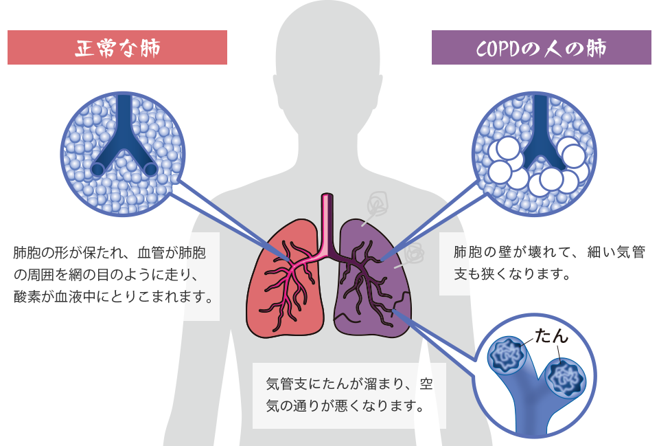 正常な肺　肺胞の形が保たれ、血管が肺胞の周囲を網の目のように走り、酸素が血液中にとりこまれます。　COPDの人の肺　肺胞の壁が壊れて、細い気管支も狭くなります。気管支にたんが溜まり、空気の通りが悪くなります。