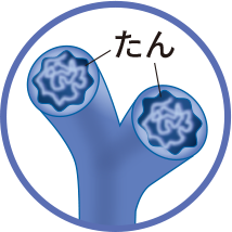 イメージ　気管支にたんが溜まり、空気の通りが悪くなります。